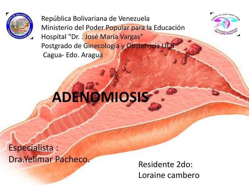 Adenomiosis 