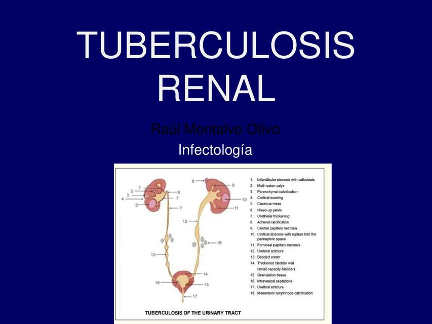 Resúmenes de Tuberculosis renal | Descarga apuntes de Tuberculosis renal