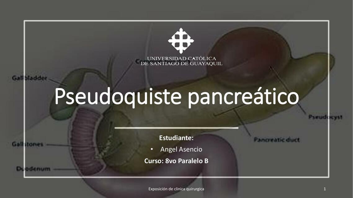 Pseudoquiste pancreatico