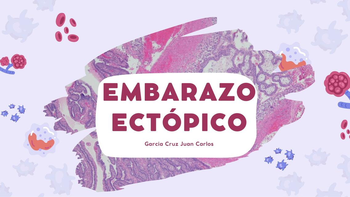 Embarazo ectópico