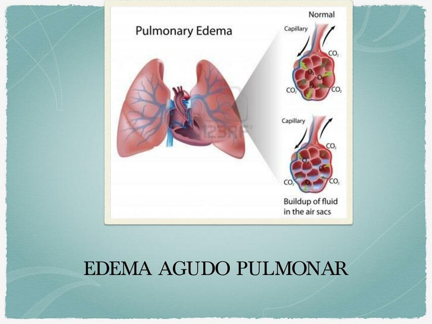 Edema agudo pulmonar