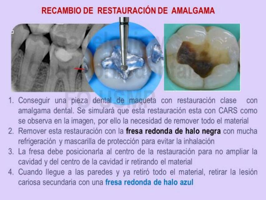 Recambio de Restauración de Amalgama 