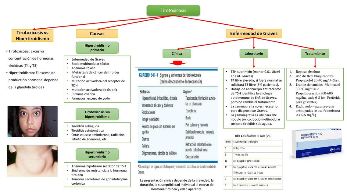 Hipertiroidismo