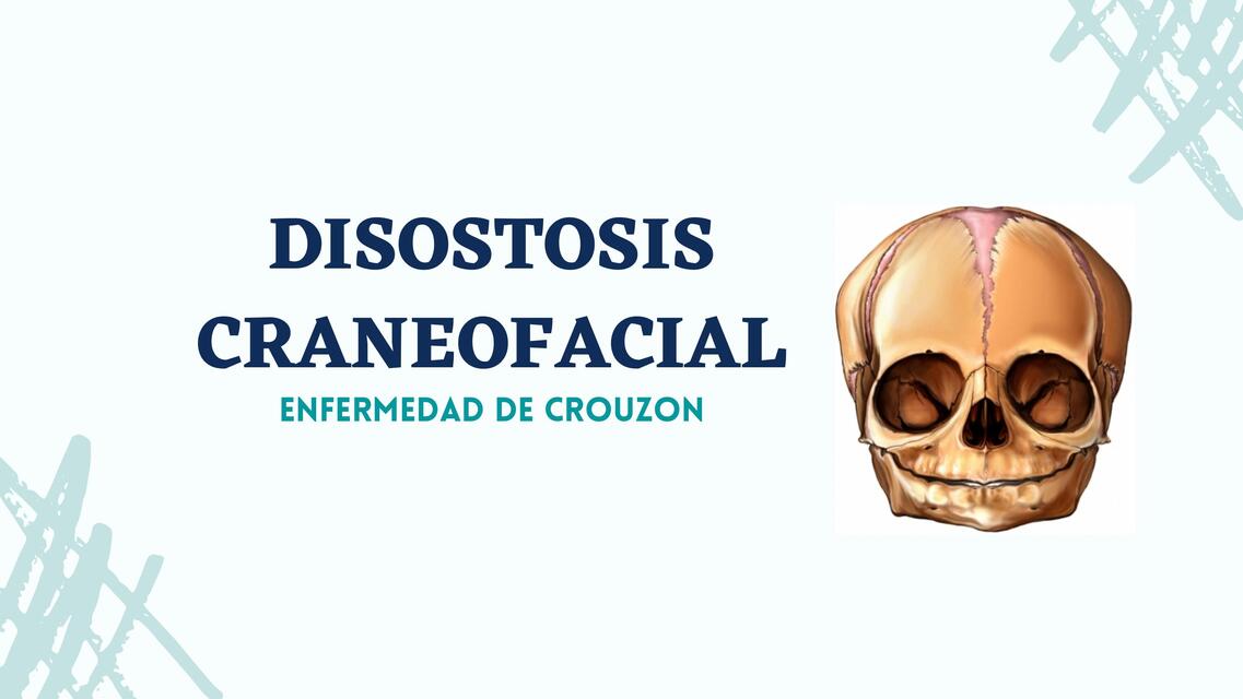 Disostosis craneofacial