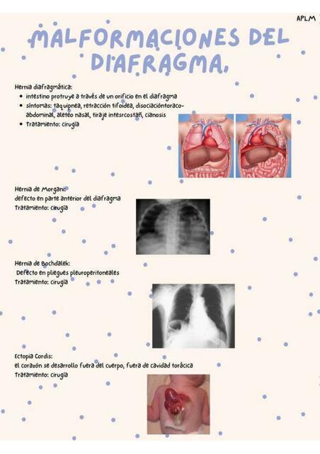Malformaciones del Diafragma