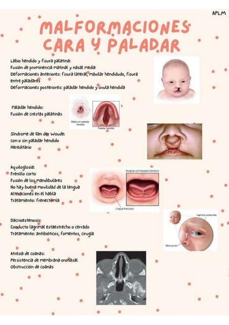 Malformaciones Cara y Paladar