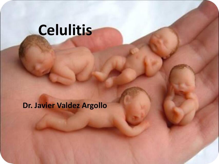 Celulitis  