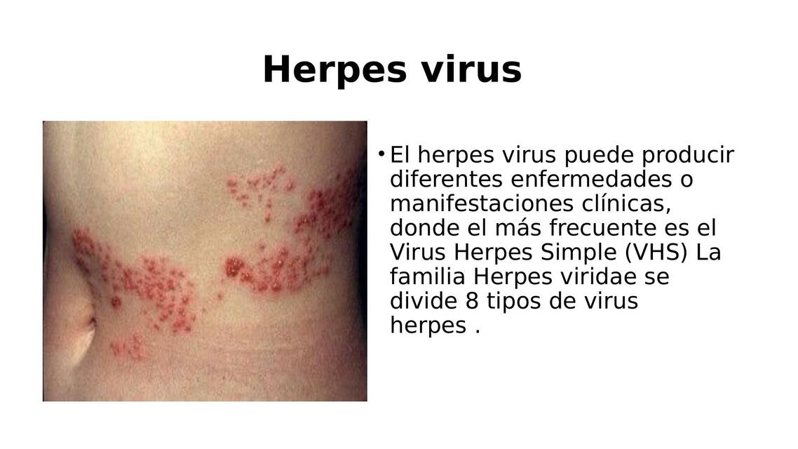 Herpes virus