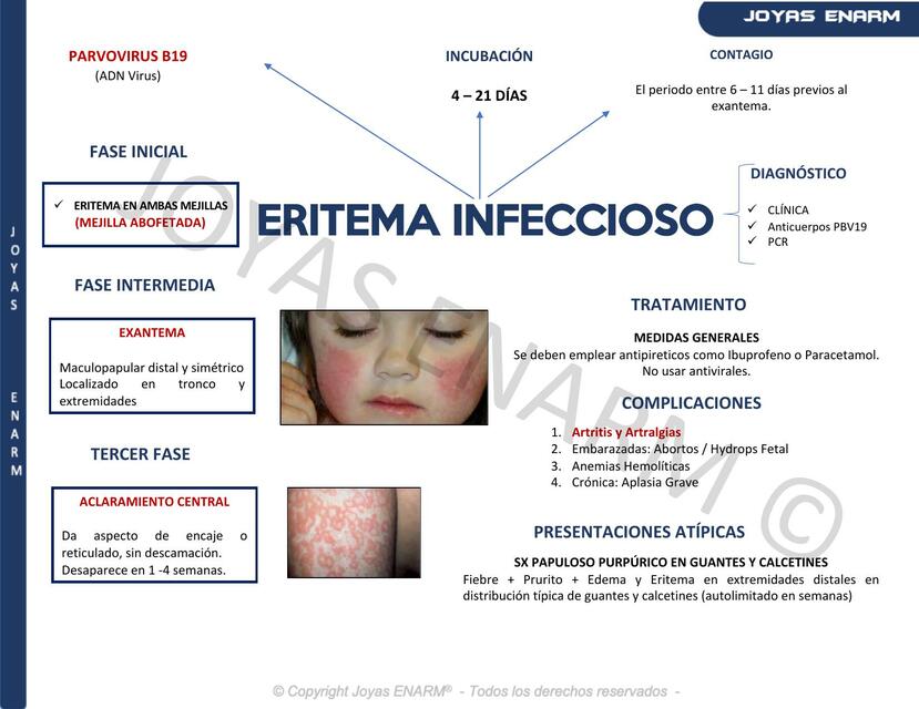 Eritema Infeccioso