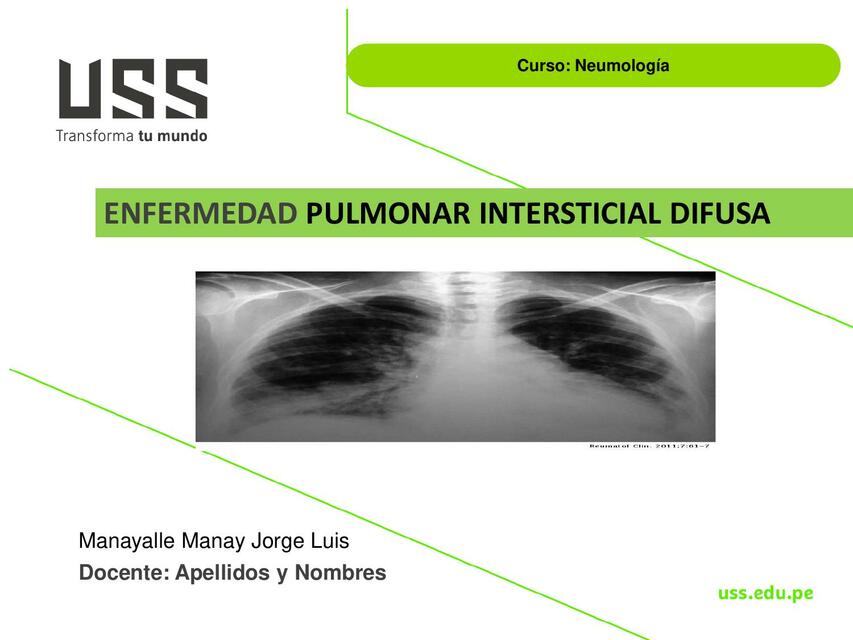 Enfermedad pulmonar intersticial difusa