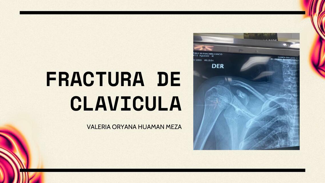 Fractura de clavícula 