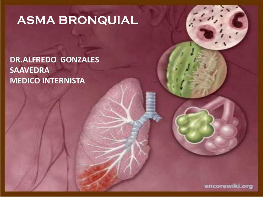 Asma bronquial