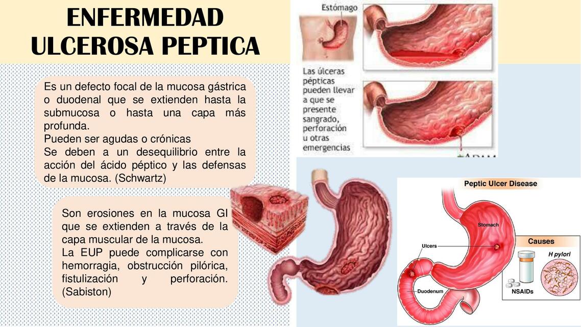 Enfermedad Ulcerosa Péptica 