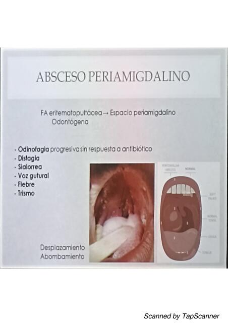 Absceso Periamigdalino 