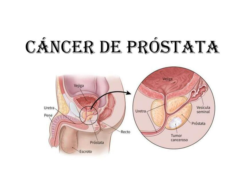 Cáncer de próstata