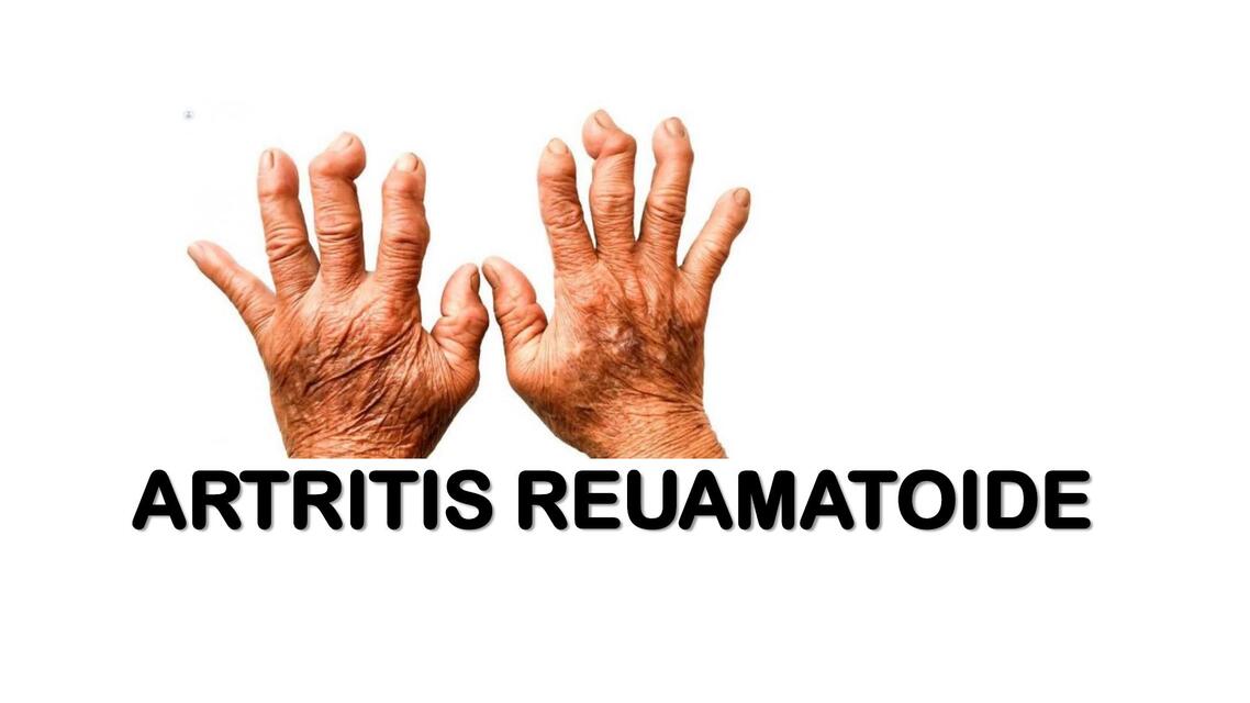 Artritis Reumatoide 