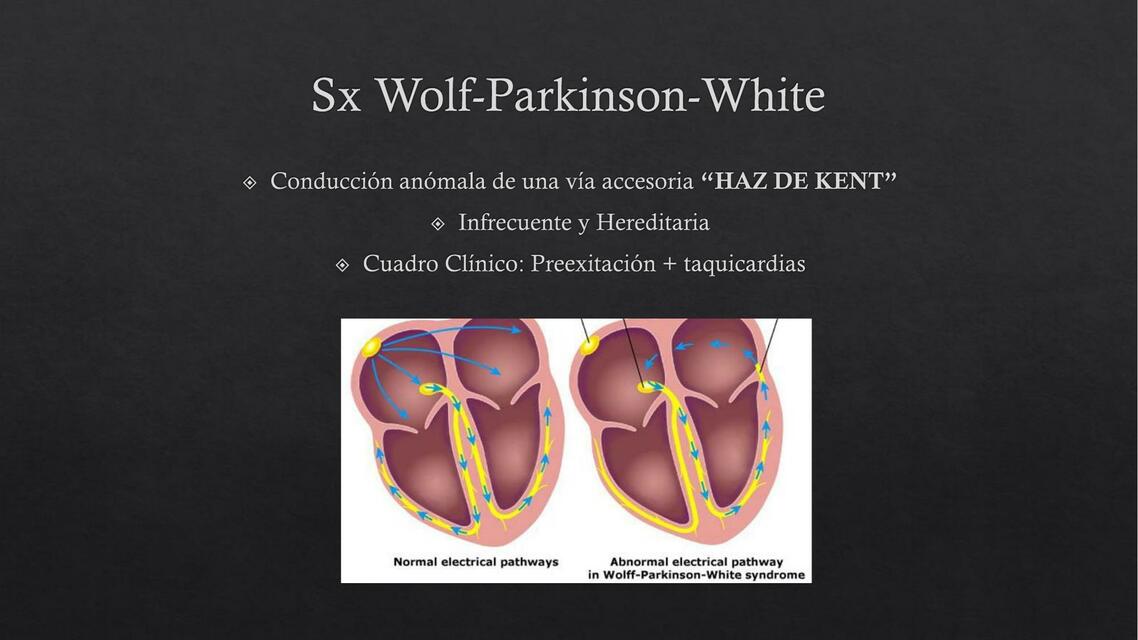 Sx Wolf Parkinson White