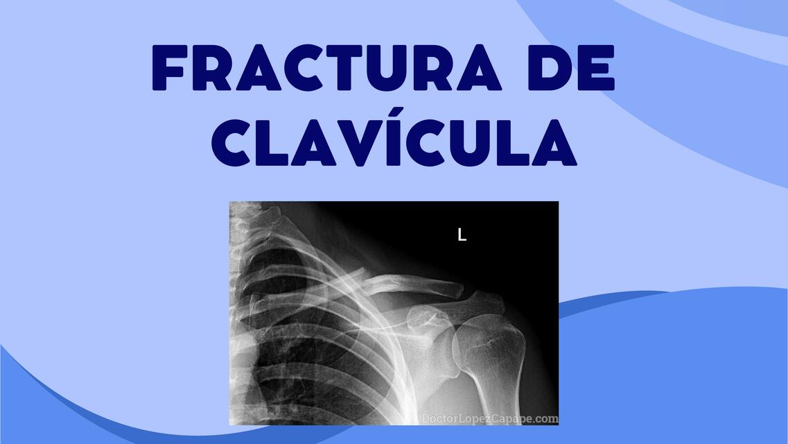 Fractura de la clavícula