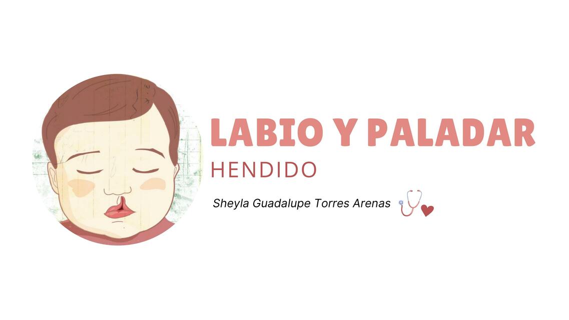 Labio y paladar hendido