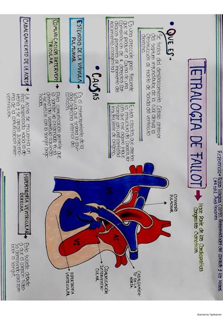 FISIOPATOLOGÍA TETRALOGÍA DE FALLOT