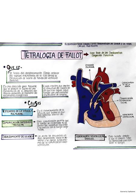 FISIOPATOLOGÍA TETRALOGÍA DE FALLOT.