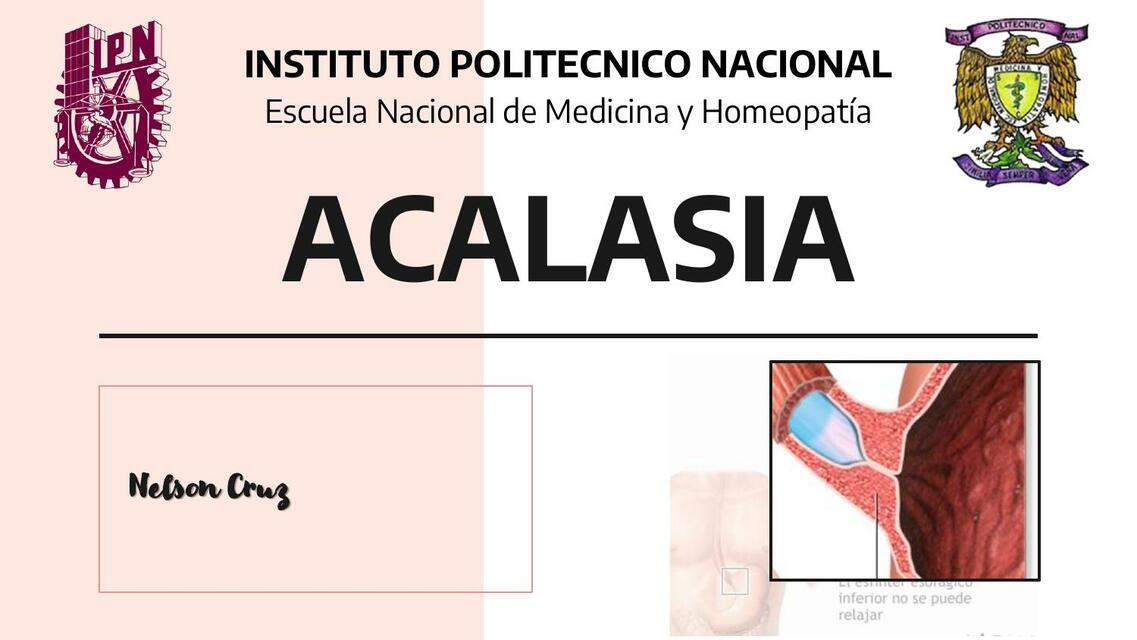 ACALASIA