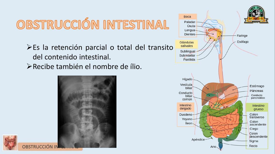 Obstruccion intestinal