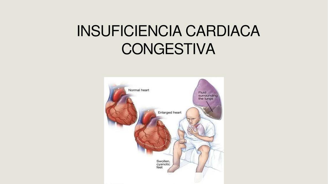 Insuficiencia Cardiaca Congestiva 