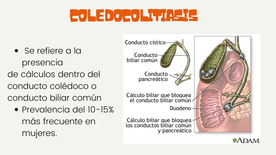 COLEDOCOLITIASIS