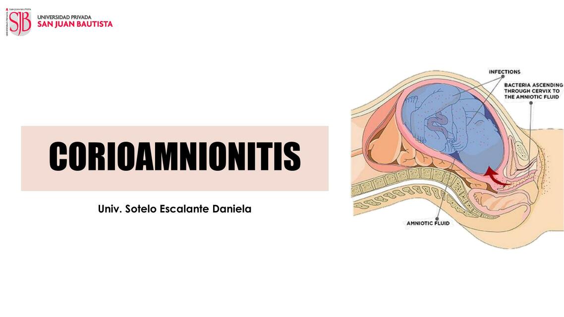 Corioamnionitis