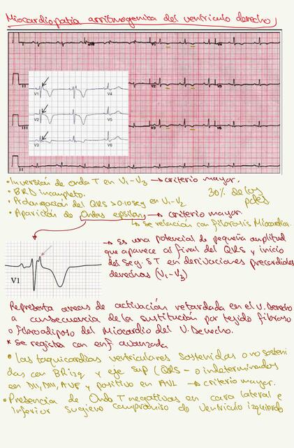 Miocardiopatia arritmogenica del ventriculo derecho en EKG