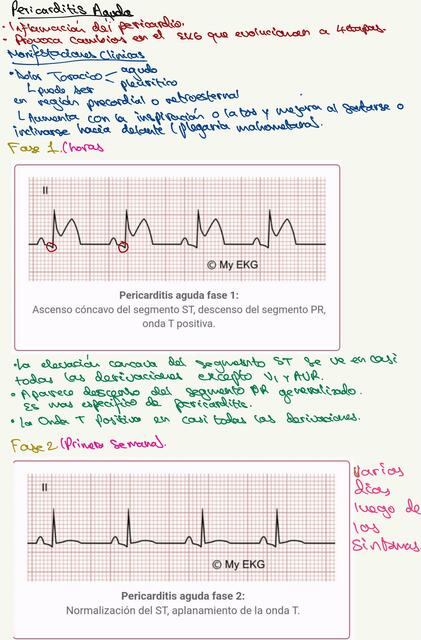 ¿Como distinguir una Pericarditis Aguda en el electrocardiograma?