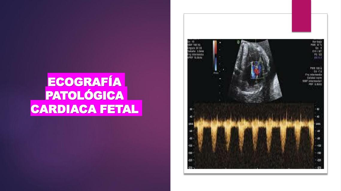 Ecografía patológica cardiaca fetal