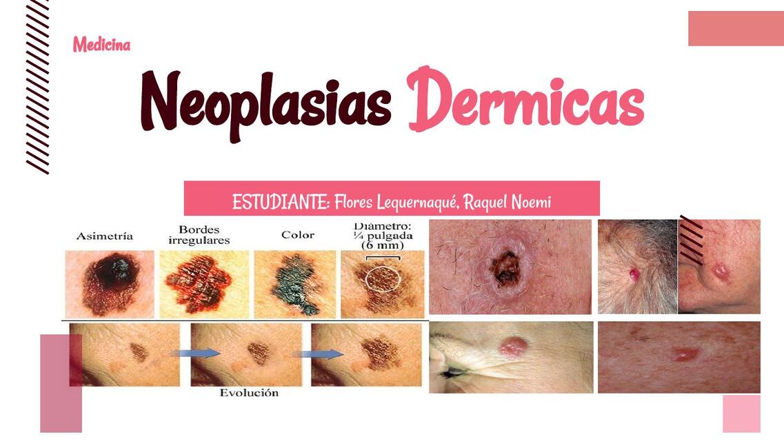 NEOPLASIAS DÉRMICAS