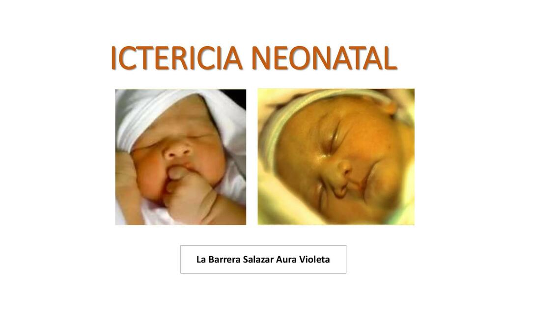 Ictericia Neonatal