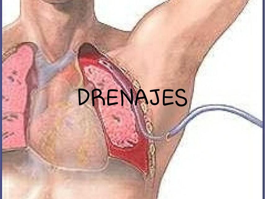 Drenajes 