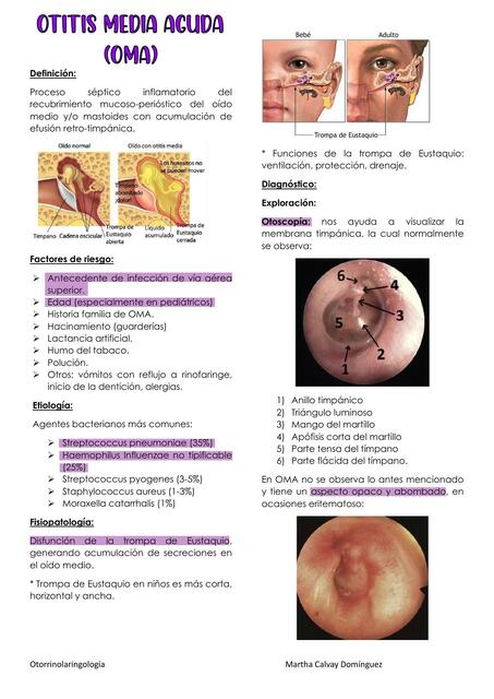 Otitis media aguda