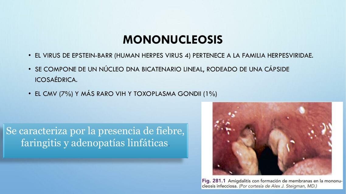 Mononucleosis 