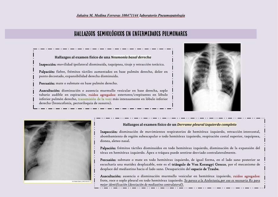 Hallazgos semiológicos en enfermedades pulmonares