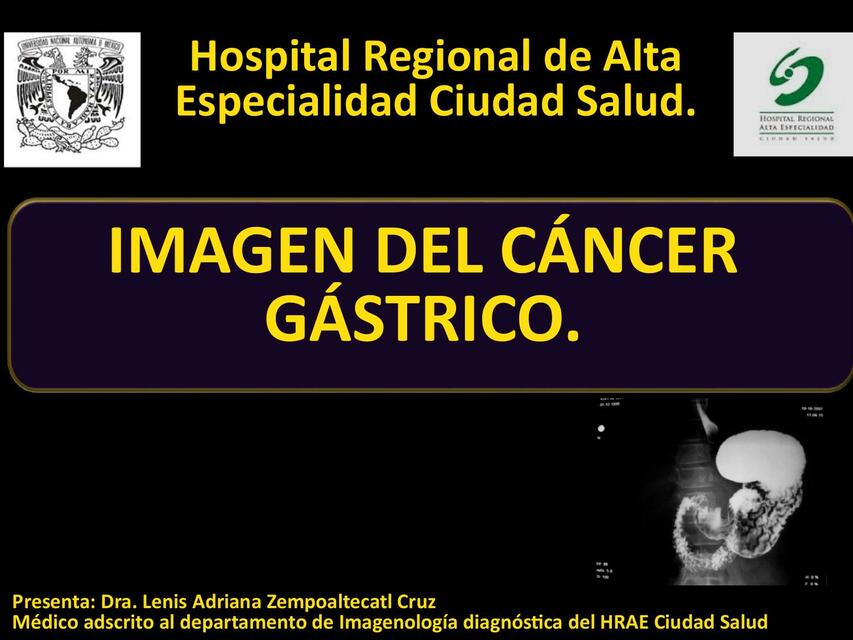 Cancer Gastrico