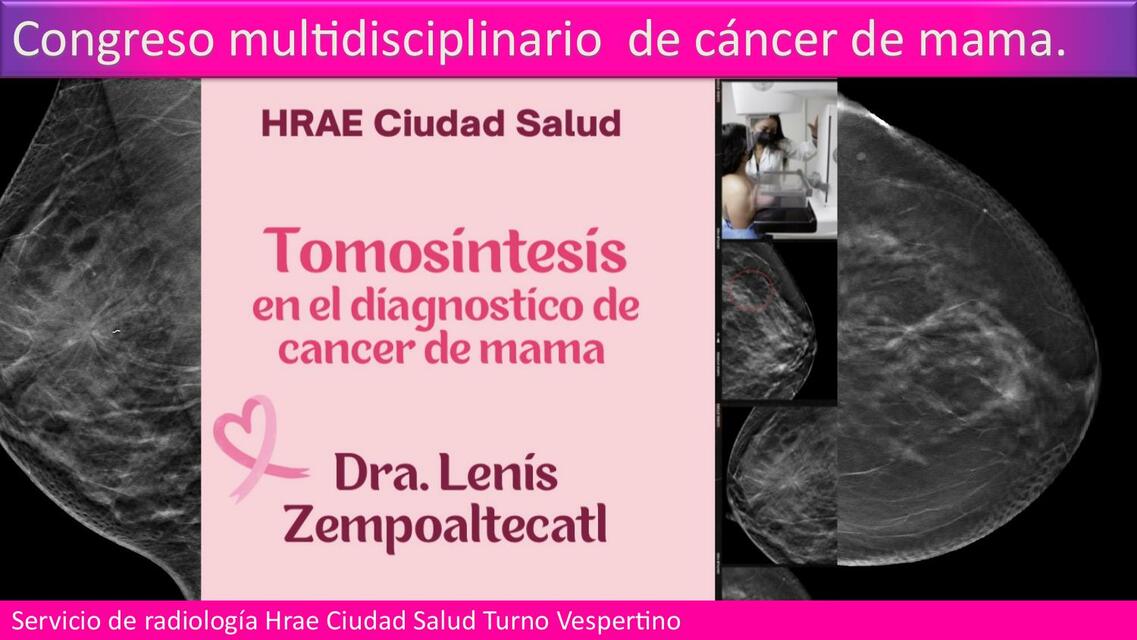 TOMOSINTESIS EN EL CANCER DE MAMA