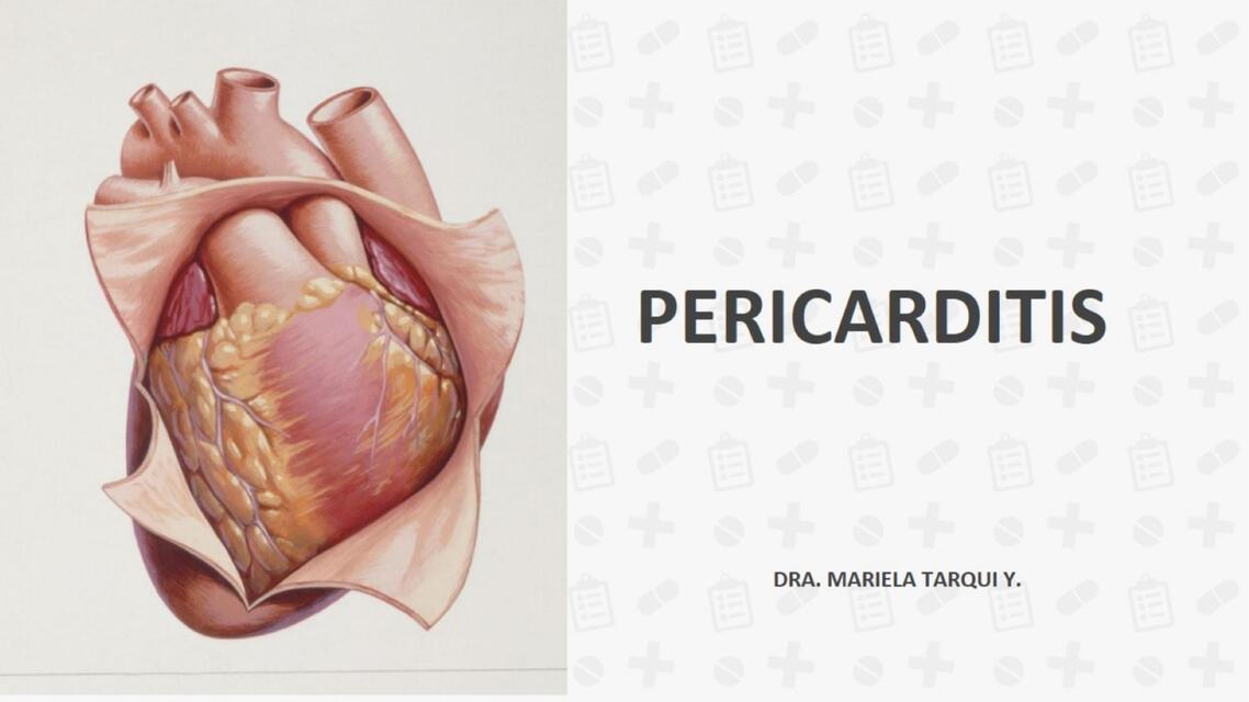 Pericarditis 