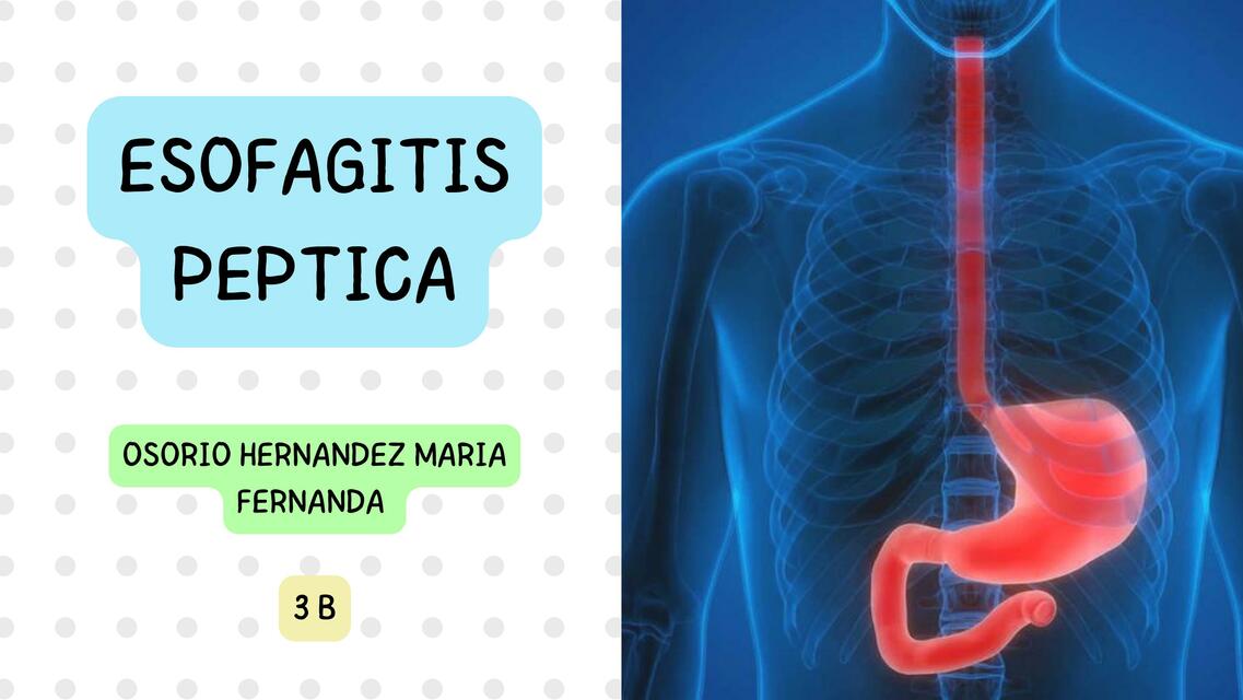 Esofagitis péptica