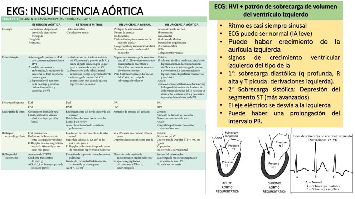 Insuficiencia Aórtica  