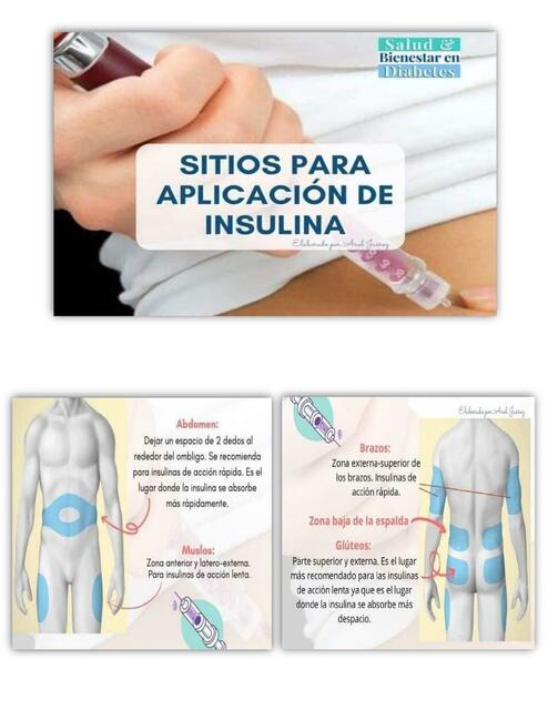 Sitios para Aplicación de Insulina 