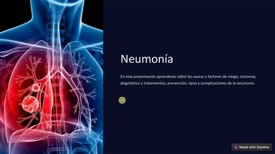 Neumonia