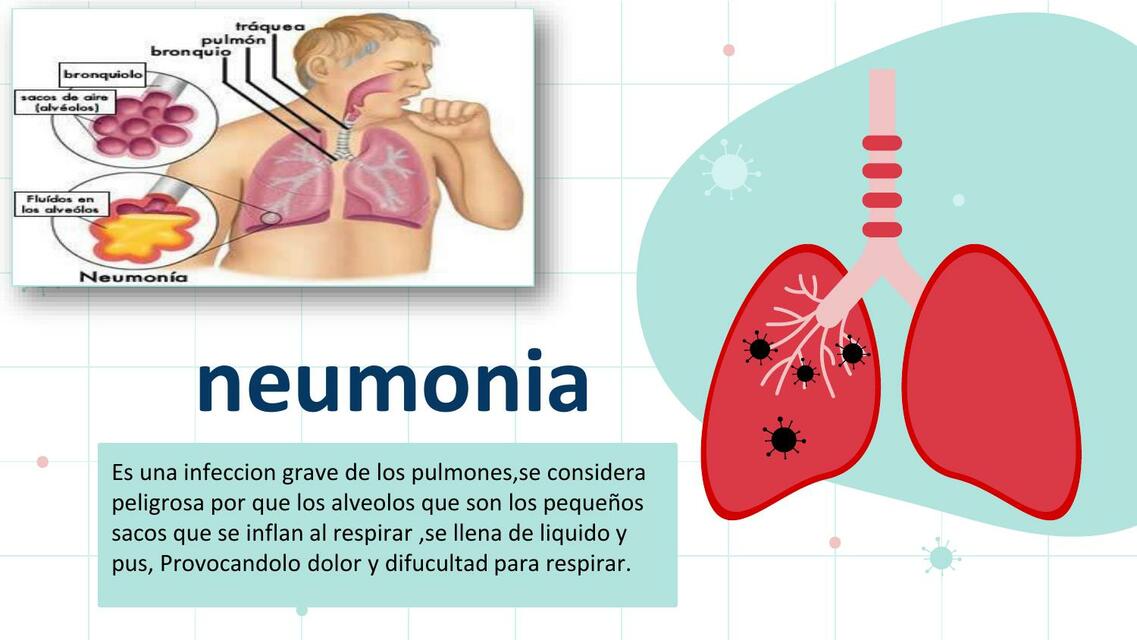 Neumonia