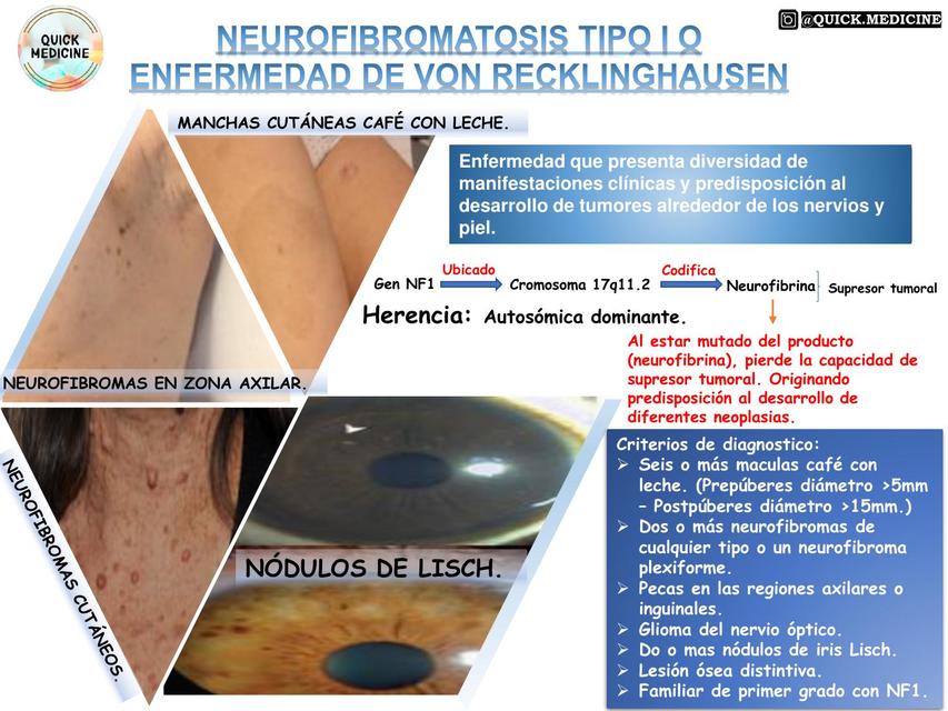 NEUROFIBROMATOSIS TIPO I O ENFERMEDAD DE VON RECKLINGHAUSEN | Quick