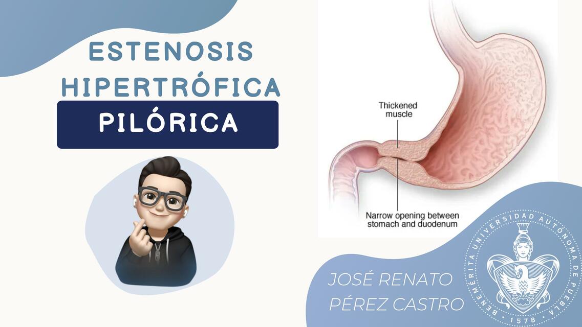 Estenosis hipertrófica del píloro | Renato Perez | uDocz