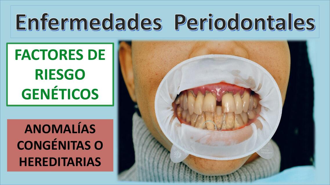 Enfermedades Periodontales: ANOMALÍAS CONGÉNITAS o Hereditarias